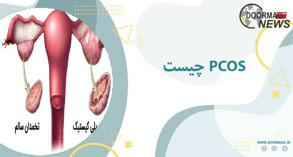 سندرم تخمدان پلی کیستیک (PCOS) چیست